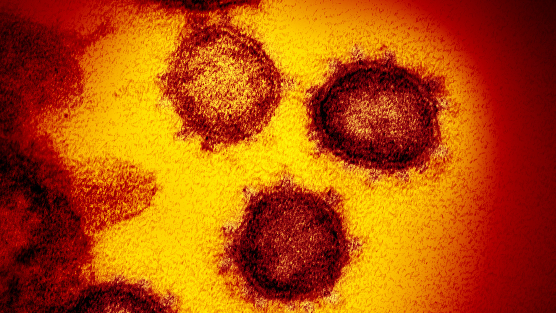 Die Elektronenmikroskopaufnahme zeigt das Coronavirus SARS-CoV-2.