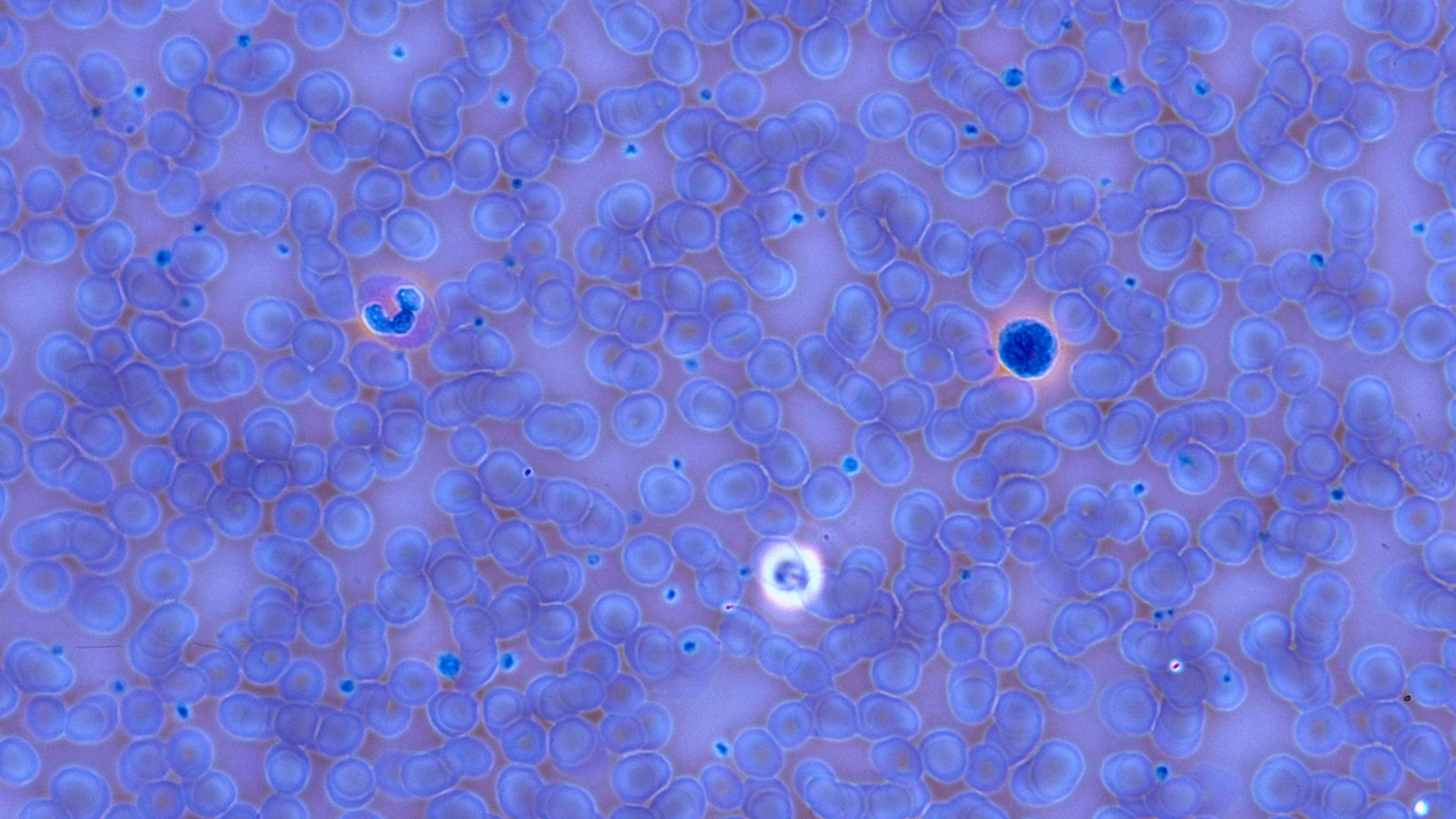 Mikroskop-Aufnahme einer infektiösen Mononukleose durch das Epstein-Barr Virus im Blutbild. | picture-alliance / OKAPIA KG, Ge