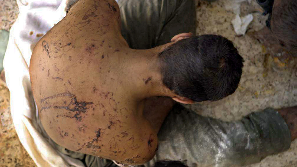 Auf dem Rücken eines Mannes sind Wunden von Folterungen zu sehen