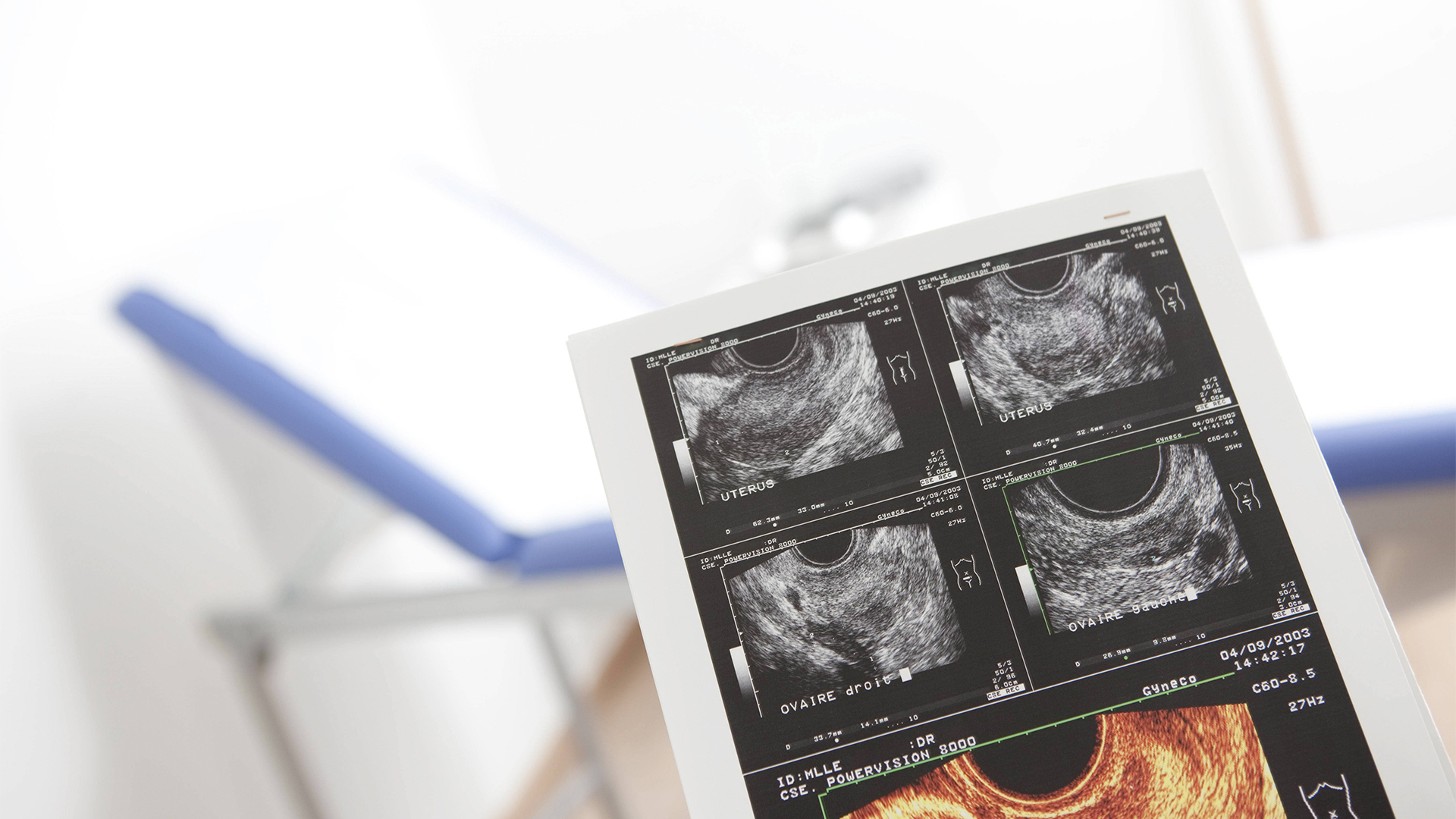 Ultraschallbild beim Frauenarzt | picture alliance