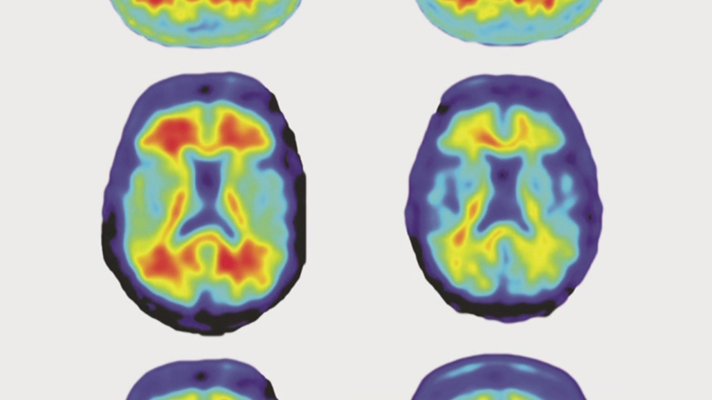 Alzheimer-Forschung - Gehirnforschung | Screenshot tagesschau-Bericht