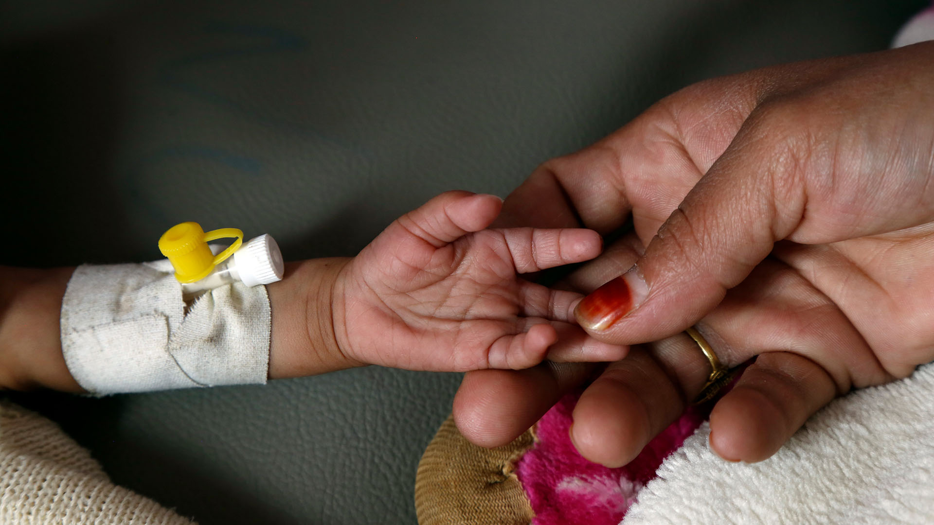 Die Hand einer Frau hält die Hand eines unterernährten Kindes.