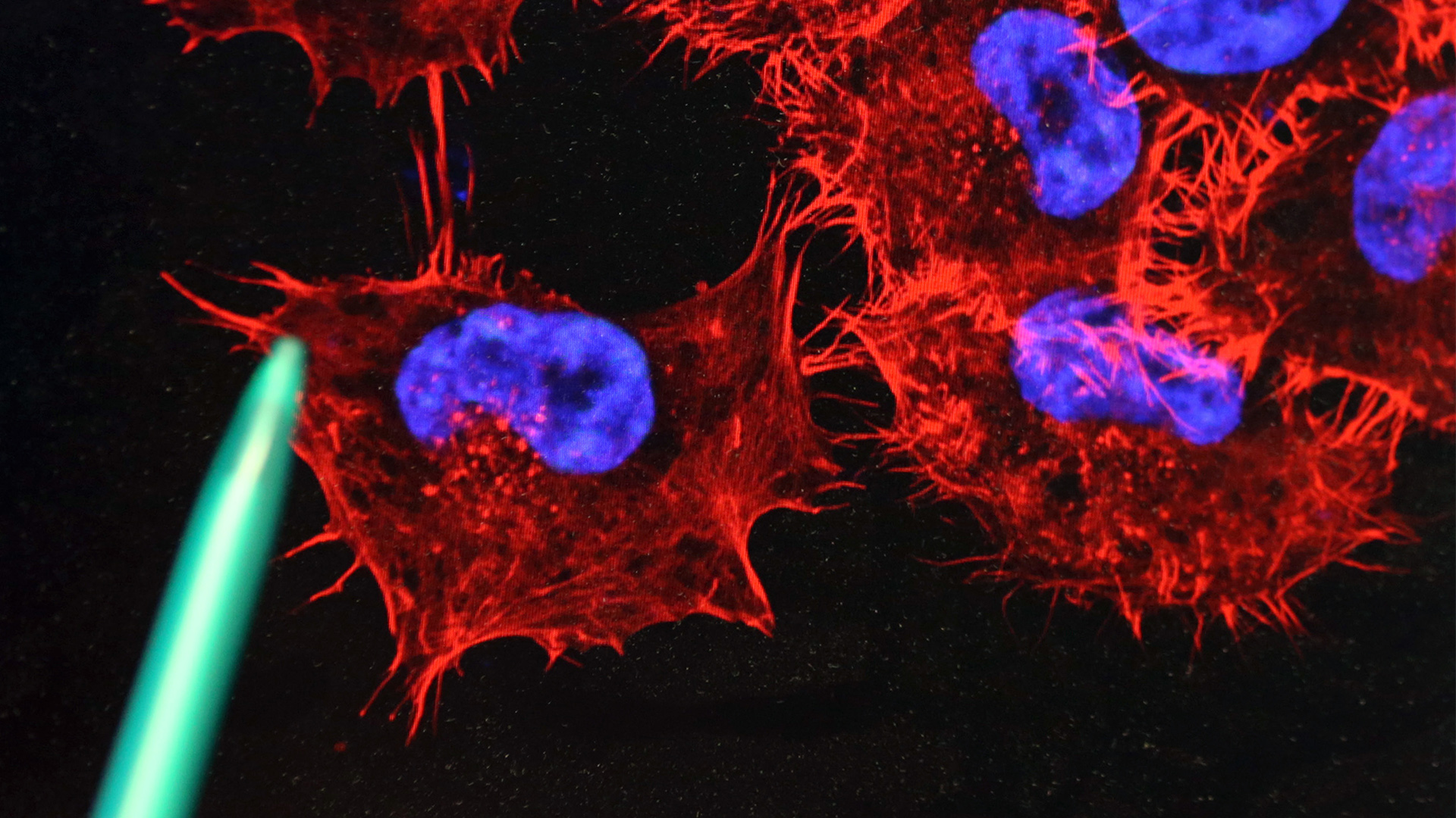 Monitor, auf dem ein Bild von Melanom-Zellen (schwarzer Hautkrebs) zu sehen ist | 