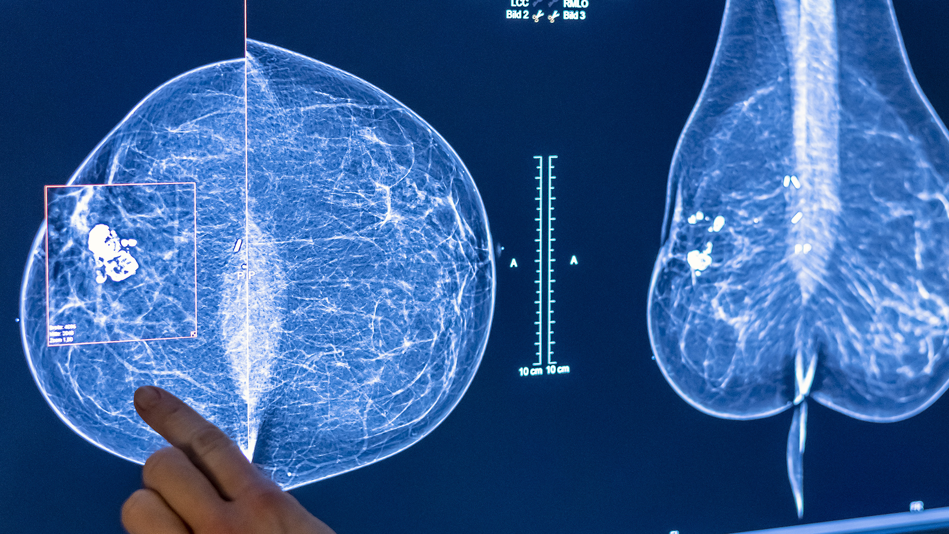 Mammografiebild