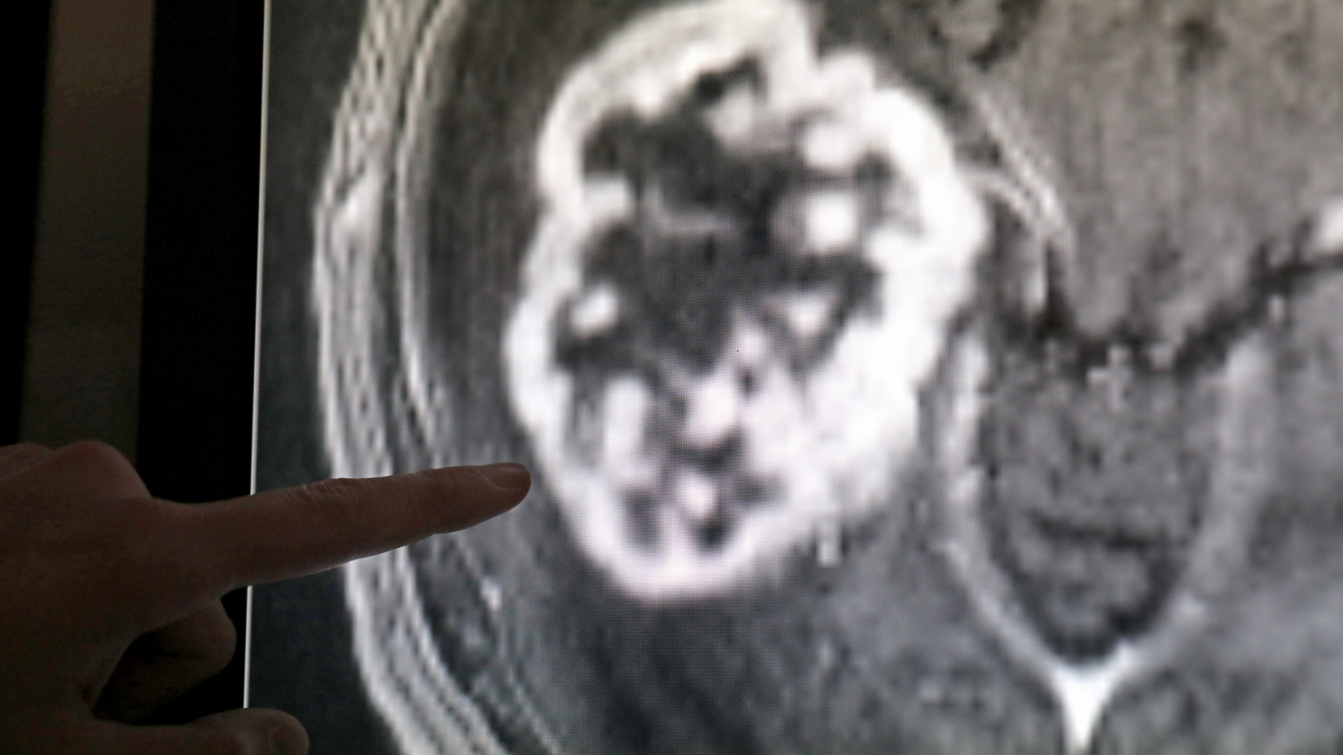 In einem MRT-Bild ist ein Tumor zu erkennen. | dpa