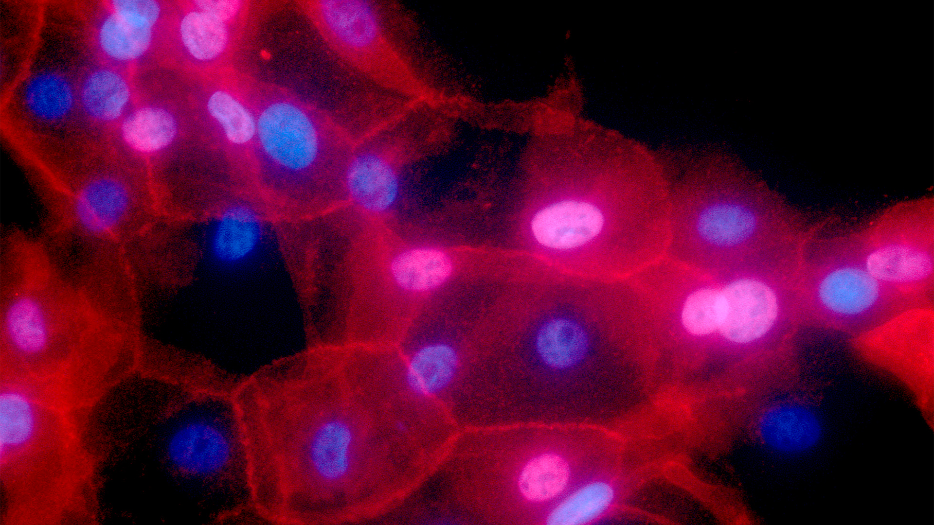 Eingefärbte Mikroskopaufnahme von menschlichen Krebszellen