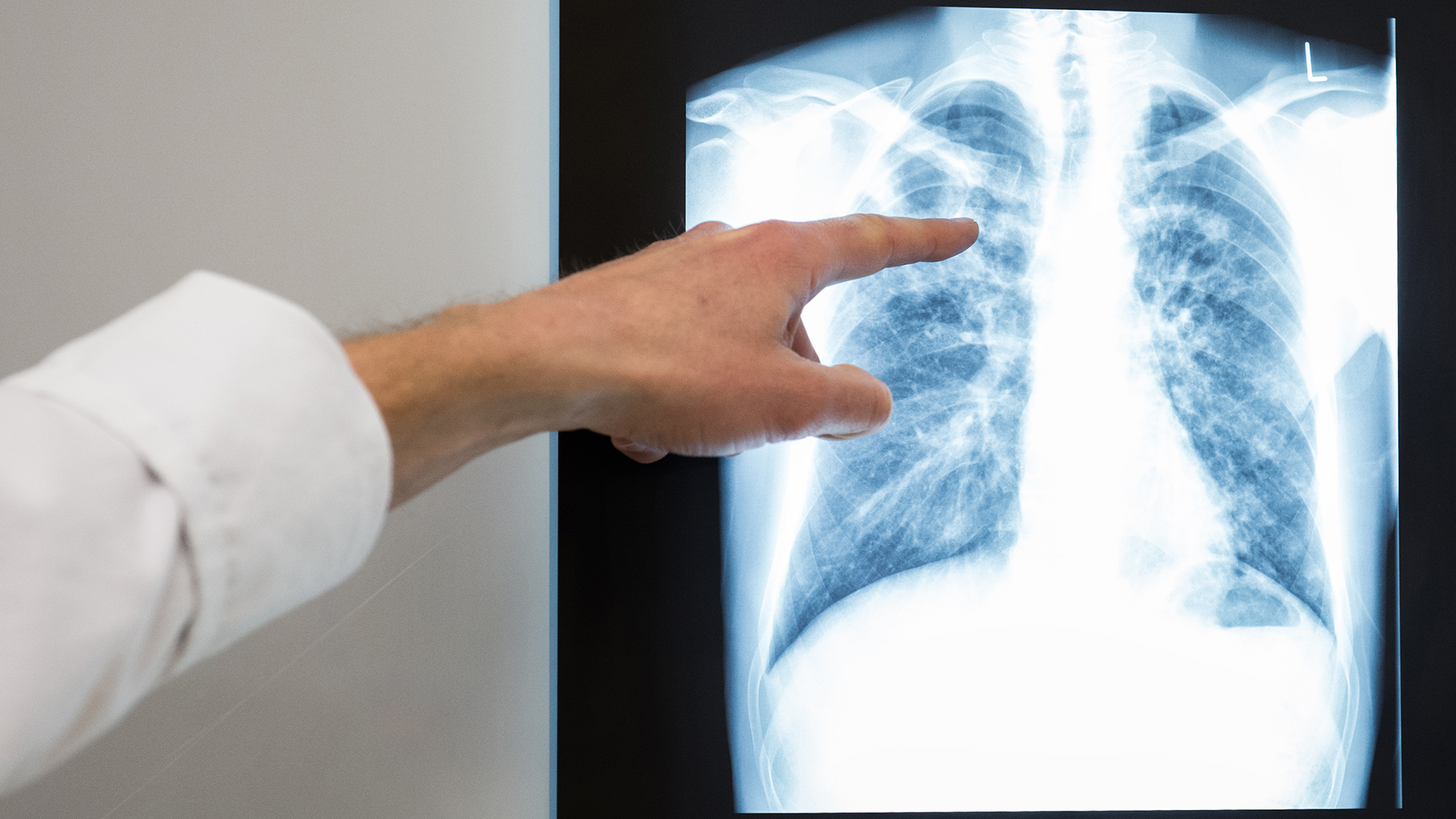 Ein Arzt zeigt auf das Röntgenbild einer Lunge. | picture alliance/dpa
