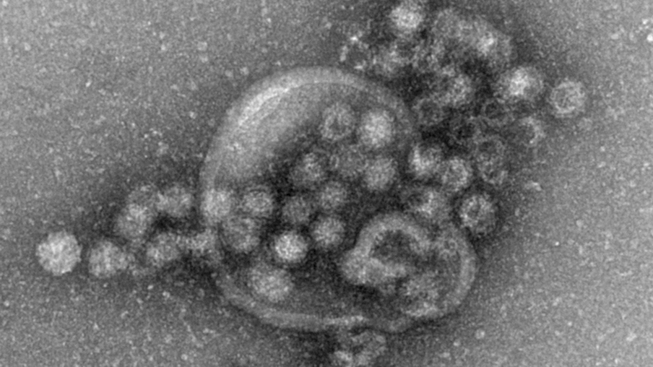 Norovirus: Neuer Stamm schuld an Tausenden neuen Fällen
