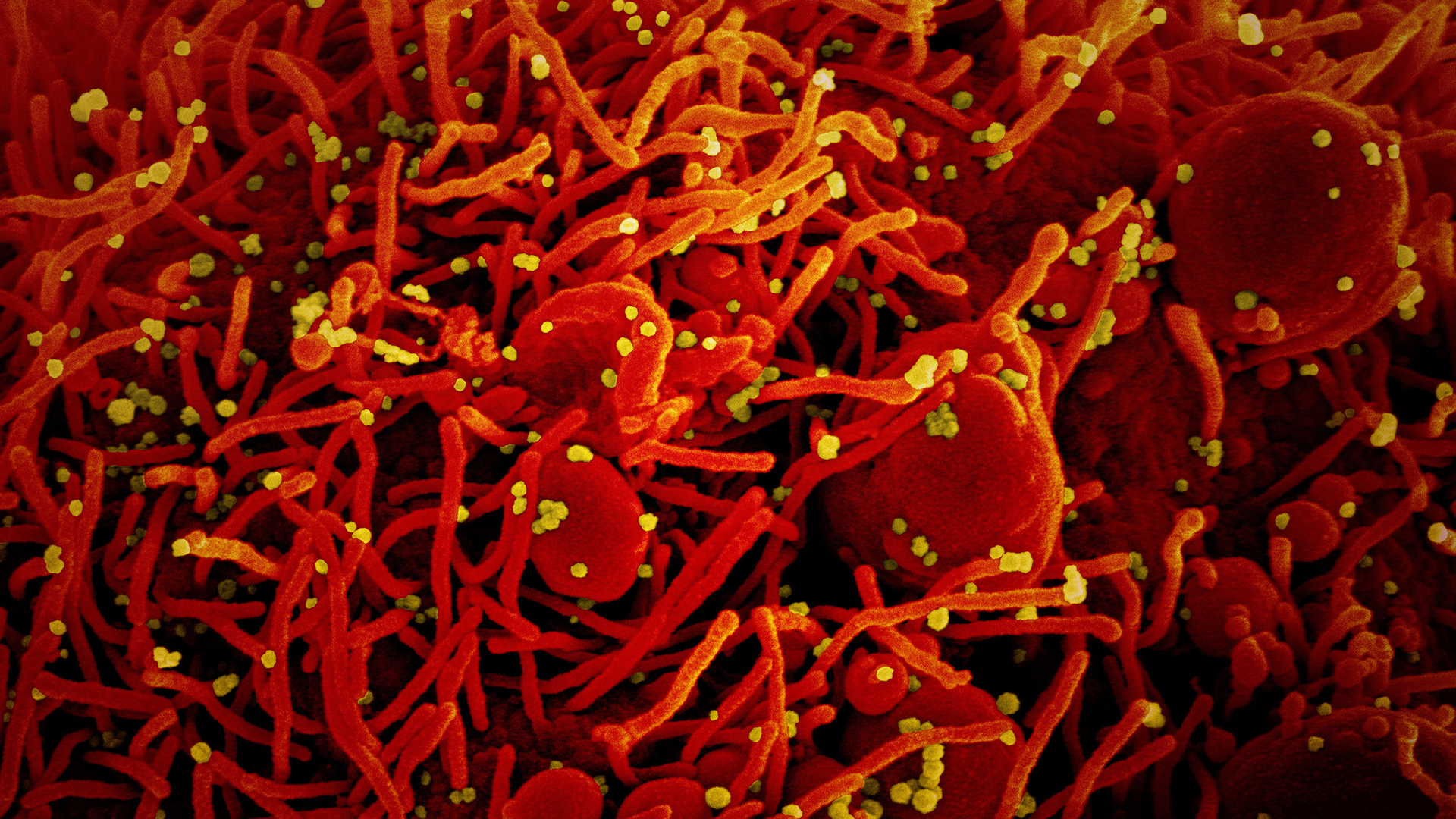 Mikroskopische Aufnahme einer von Sars-CoV-2 befallene Zelle | Niaid/Europa Press/dpa 