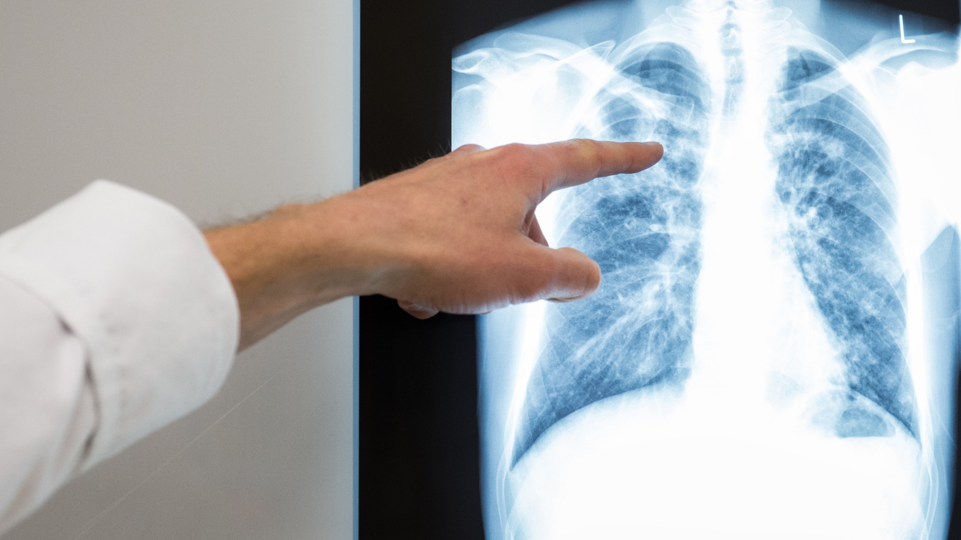 Eine Röntgenaufnahme einer an Tuberkulose infizierten Lunge. | dpa