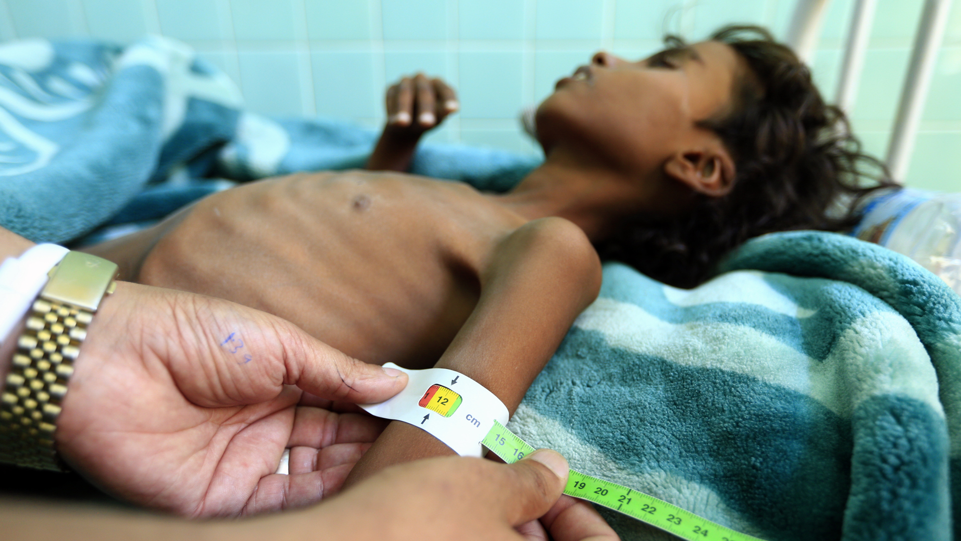 Eine Ärztin misst den Armumfang eines mangelernährten zwölfjährigen Jungen im Jemen. | Â© UNICEF/UN0253355/ Huwais