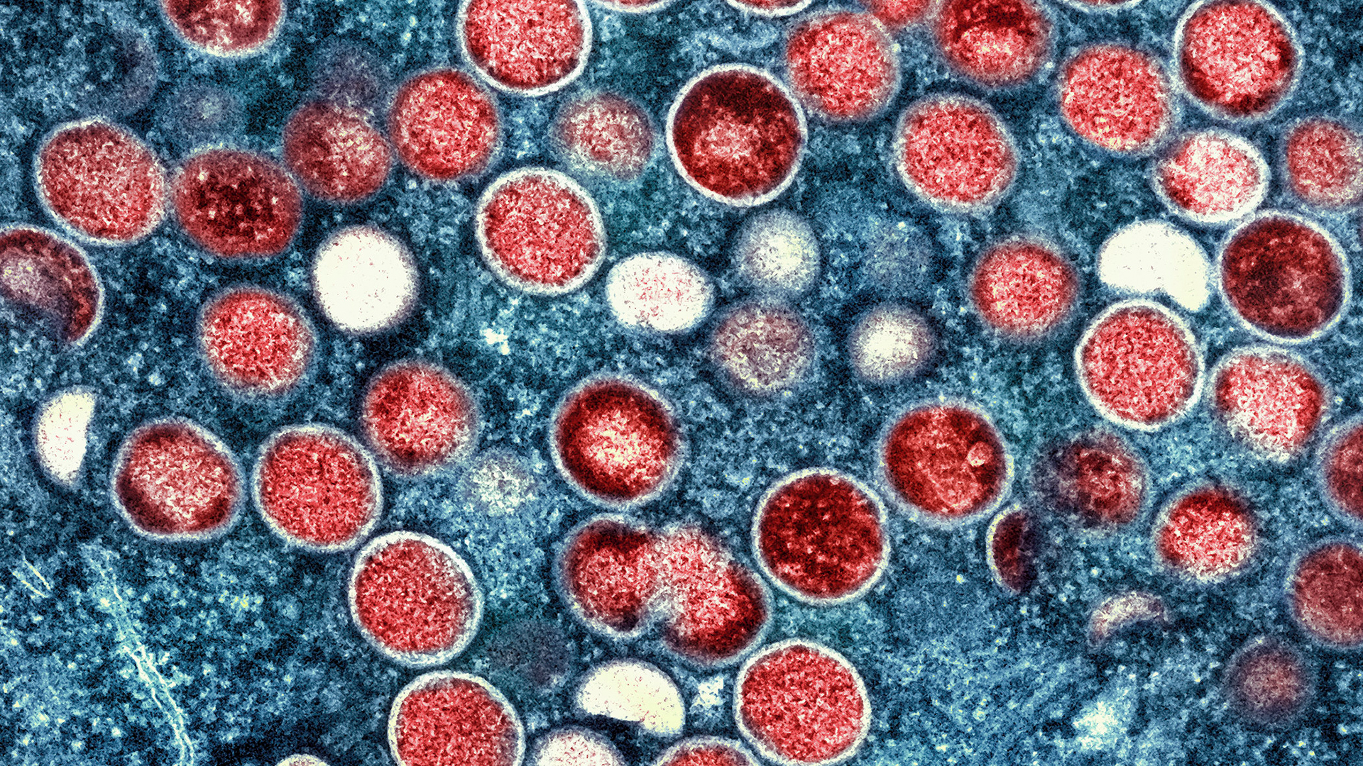 Eingefärbte Transmissionselektronenmikroskopaufnahme von Affenpockenpartikeln (rot) in einer infizierten Zelle (blau). | AP
